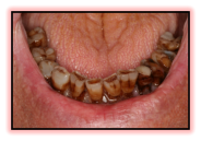 Arcata inferiore denti naturali